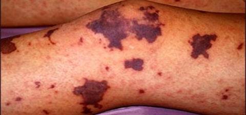 The Purple disease | causes, symptoms and treatment